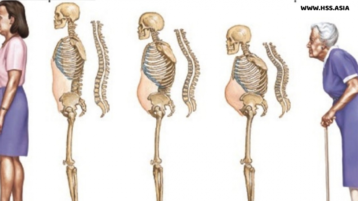 Loãng xương ảnh hưởng đến sức khoẻ người cao tuổi