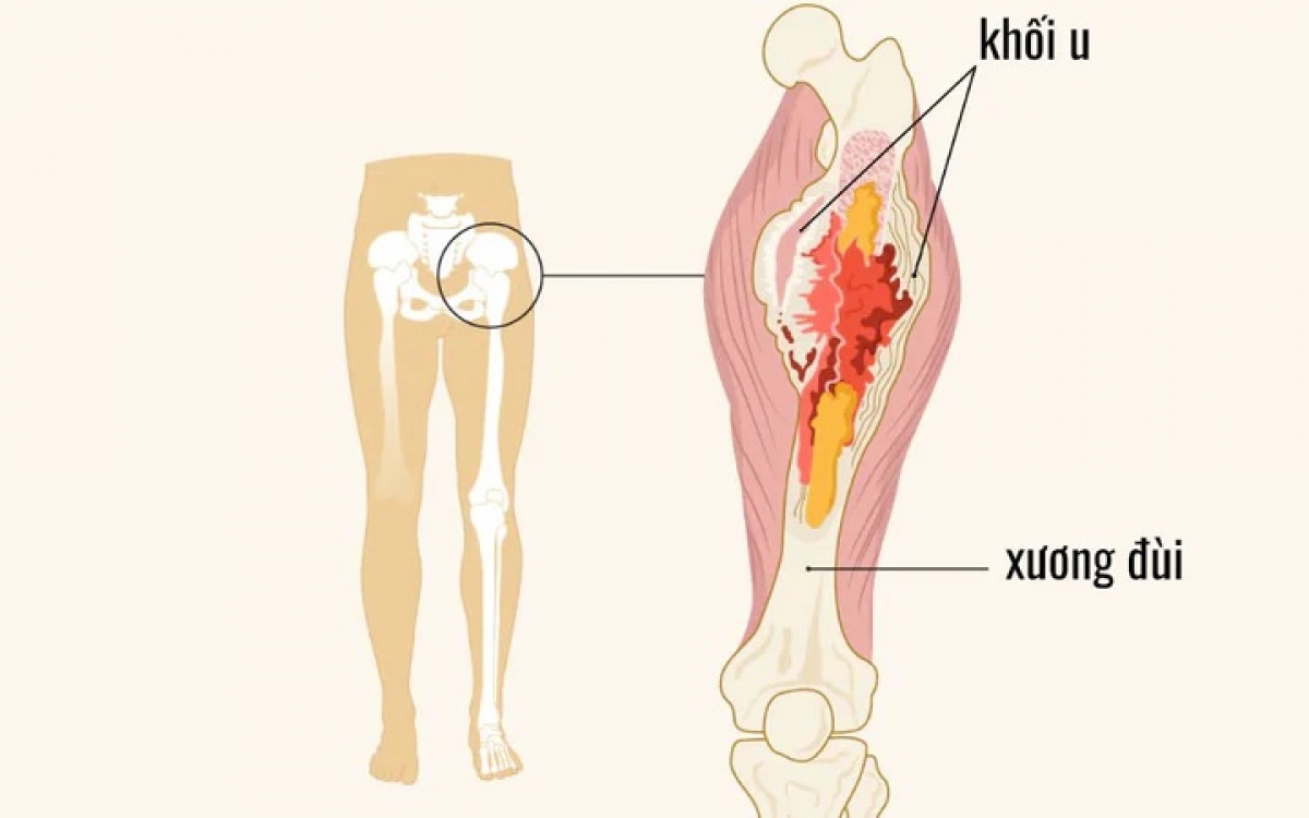 Sưng, đau không có nguyên nhân cụ thể là hai dấu hiệu có thể cảnh báo ung thư xương ở trẻ (Ảnh minh họa AI)
