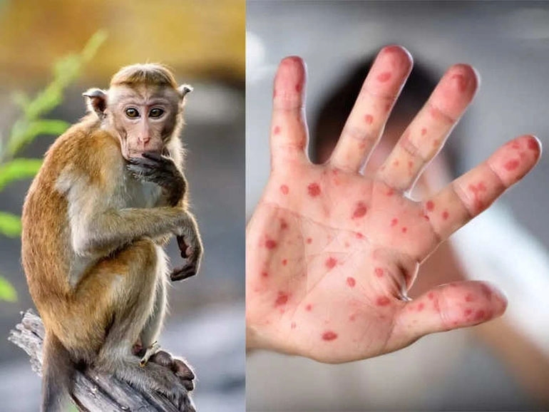 Họp khẩn về bệnh đậu mùa khỉ đang được tổ chức để tìm cách đối phó với dịch bệnh. Xem hình ảnh để cập nhật thông tin nhanh và chính xác nhất.