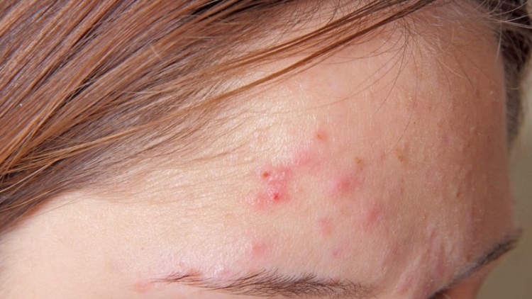 Viêm da do ký sinh trùng lại tưởng mụn trứng cá thông thường
