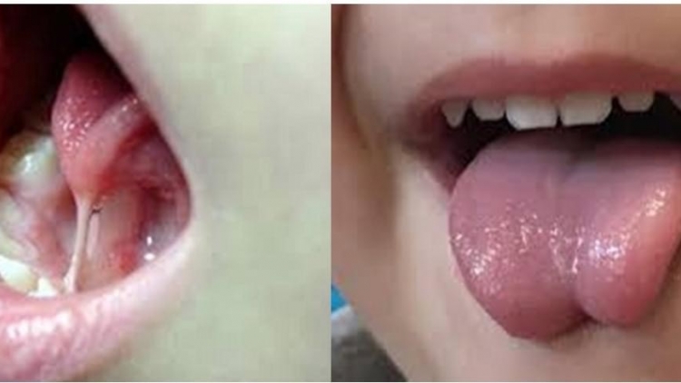 Bác sĩ cảnh báo trào lưu cắt thắng lưỡi ở trẻ