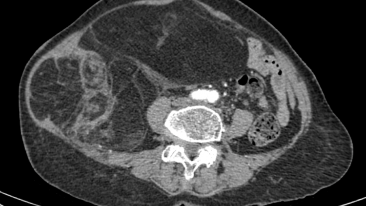 Bệnh nhân 76 tuổi bị khối u ác tính hiếm gặp được phẫu thuật thành công