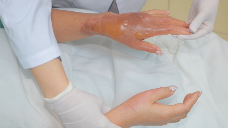 Bác sĩ cảnh báo nguy cơ bỏng hóa chất từ bột thông bồn cầu