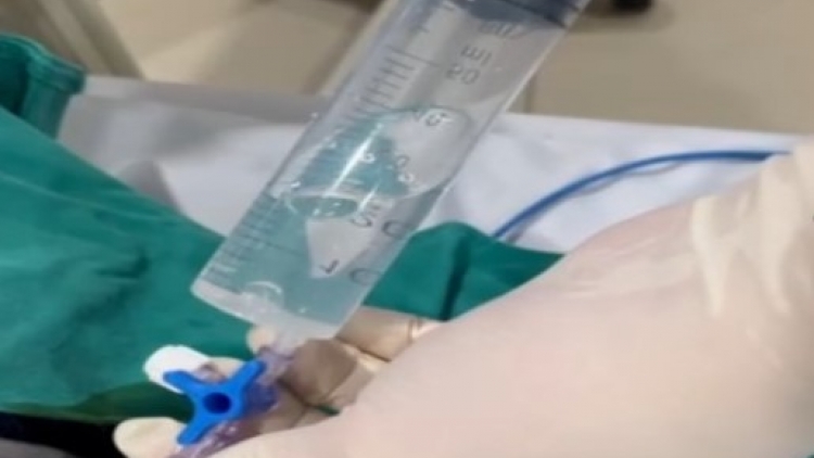 Cứu sống bệnh nhân bị tràn khí màng phổi mức độ nặng do vỡ kén khí