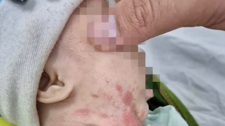 Trẻ 3 tuổi bị giang mai bẩm sinh lây từ mẹ