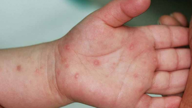 Bộ Y tế chỉ đạo khẩn khi dịch tay chân miệng diễn biến khó lường