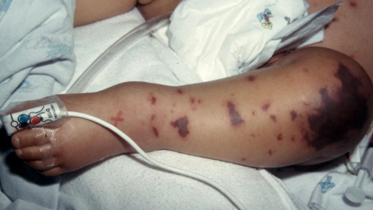 Viêm não mô cầu- một bé gái tử vong