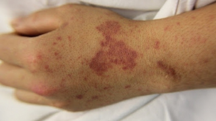 24 ca mắc, 4 ca tử vong do não mô cầu