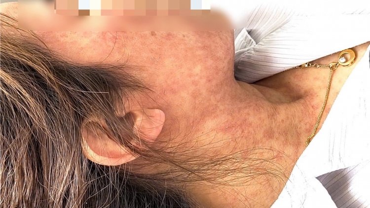 Đừng xem nhẹ bệnh sởi ở người lớn