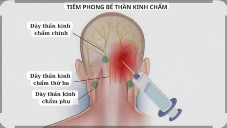 Đau đầu không khỏi, nhiều bệnh nhân cải thiện nhờ kỹ thuật này