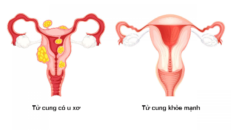 Phát hiện u xơ tử cung hơn 30cm khi khám sức khỏe định kỳ