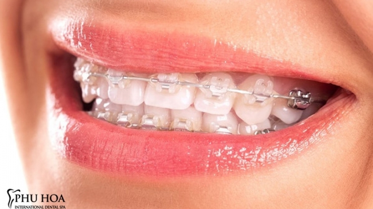  "Thời điểm vàng” chỉnh nha điều trị khớp cắn ngược cho trẻ