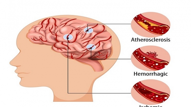 Tăng huyết áp ảnh hưởng tới não bộ ra sao?