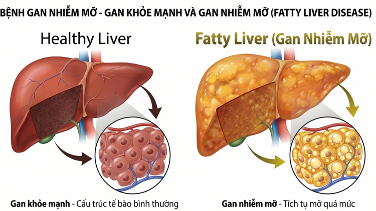 Gan nhiễm mỡ gia tăng ở người trẻ