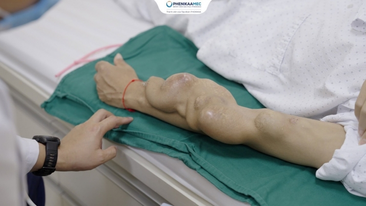 Bệnh nhân chạy thận đừng chủ quan khi cầu nối động - tĩnh mạch (AVF) có khối phình