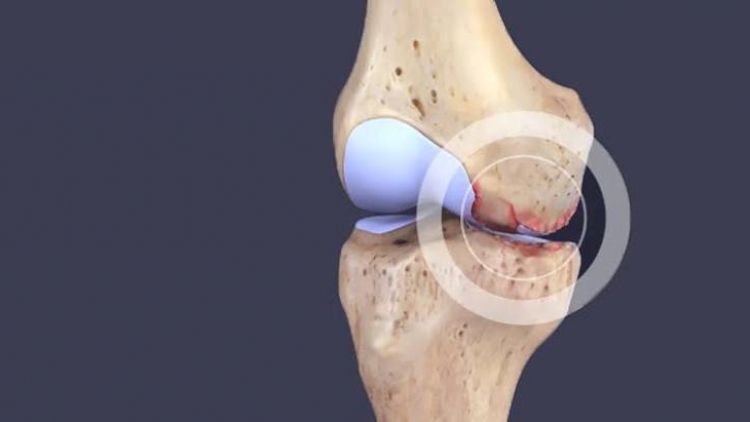 Thoái hóa khớp ngày càng trẻ hóa: 5 dấu hiệu cảnh báo không nên bỏ qua