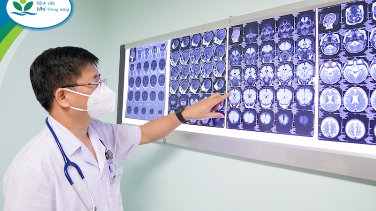 Phẫu thuật mở thêm cơ hội cho trẻ động kinh kháng thuốc