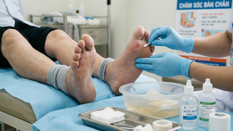 Kết hợp Đông - Tây y trong chăm sóc bàn chân cho bệnh nhân tiểu đường