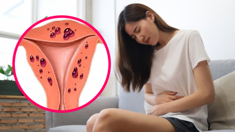 tiêm cồn điều trị lạc nội mạc tử cung