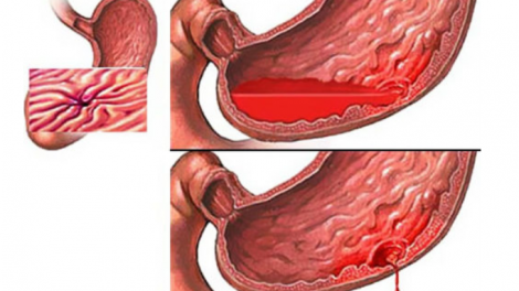 Những thói quen dẫn đến xuất huyết tiêu hóa ở người trẻ