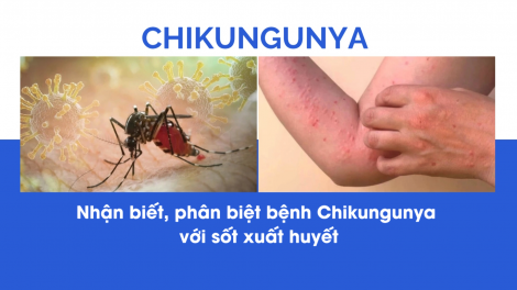 phân biệt bệnh Chikungunya với sốt xuất huyết