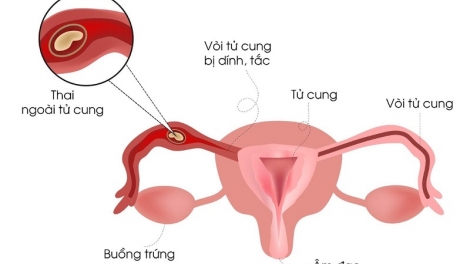 Viêm phần phụ gây vô sinh ở phụ nữ như thế nào? 