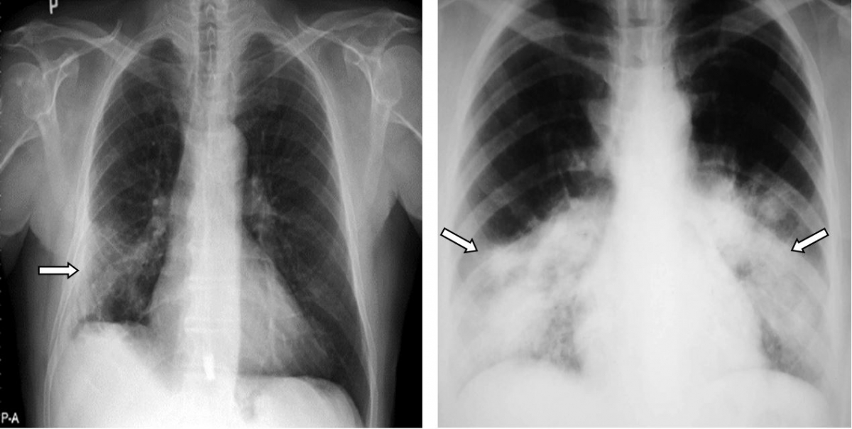  Hình ảnh tổn thương kính mờ phổi phải (ảnh trái) và đông đặc thùy dưới hai phổi (ảnh phải) trên X-quang phổi thẳng ở bệnh nhân COVID-19