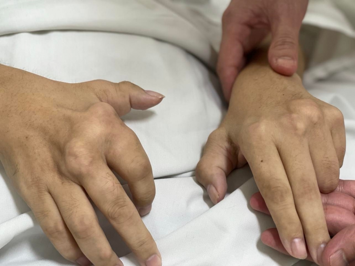Bàn tay biến dạng do gout