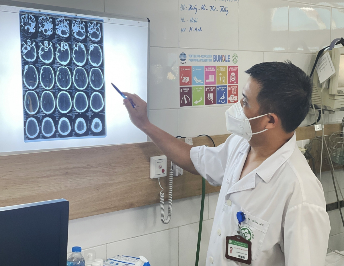 BS Nguyễn Trung Nguyên chỉ rõ hình ảnh tổn thương não của bệnh nhân ngộ độc methanol
