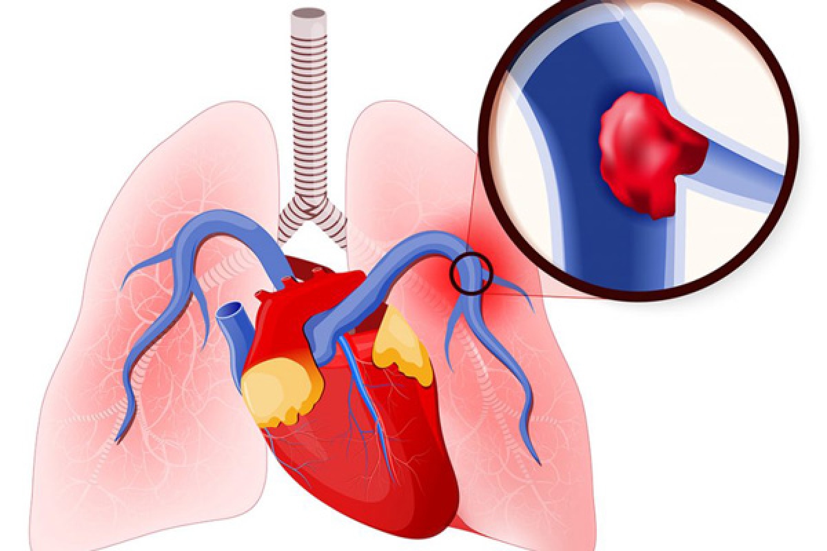 Cục huyết khối gây tắc nghẽn động mạch phổi