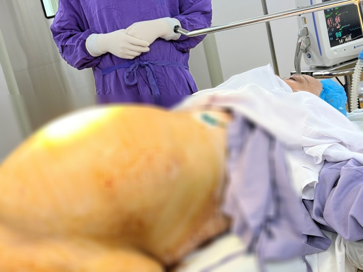 Khối u buồng trứng của bệnh nhân trước khi tiến hành phẫu thuật