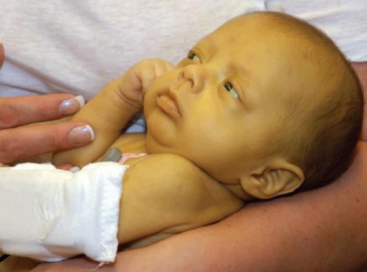 Cha mẹ theo dõi các triệu chứng vàng da, vàng mắt ở con để kịp thời đưa đi điều trị