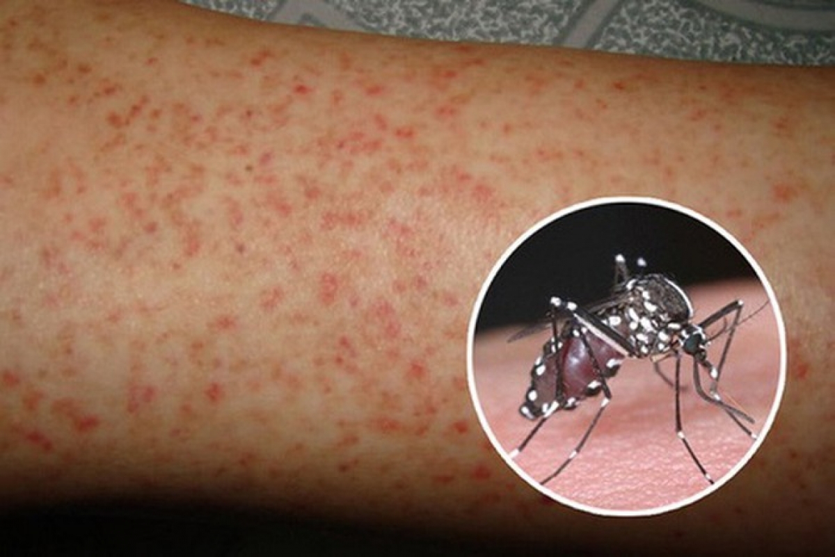 Diệt muỗi, làm sạch môi trường sống là một trong những cách phòng chống sốt xuất huyết hiệu quả