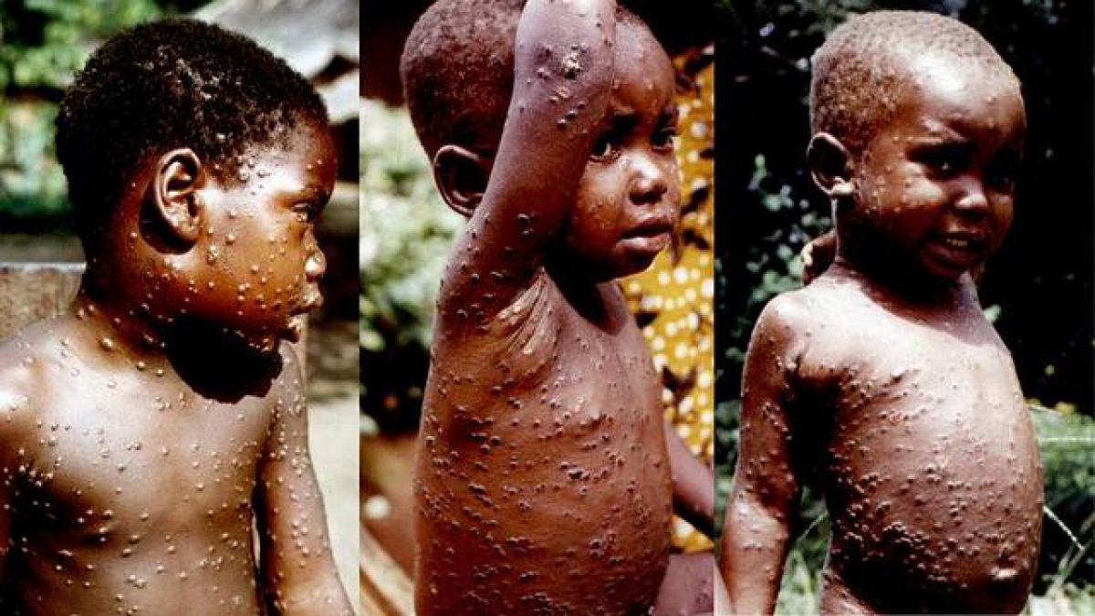 Hình ảnh kho tư liệu lưu trữ y văn - Một bé gái Zairian 7 tuổi bị bệnh đậu mùa khỉ ở giai đoạn cấp tính, ngày thứ 7 bị phát ban, và bệnh đậu mùa khỉ ở một cậu bé Zairian 3 tuổi bị phát ban ở giai đoạn đóng vảy, DRC, 1970-1977