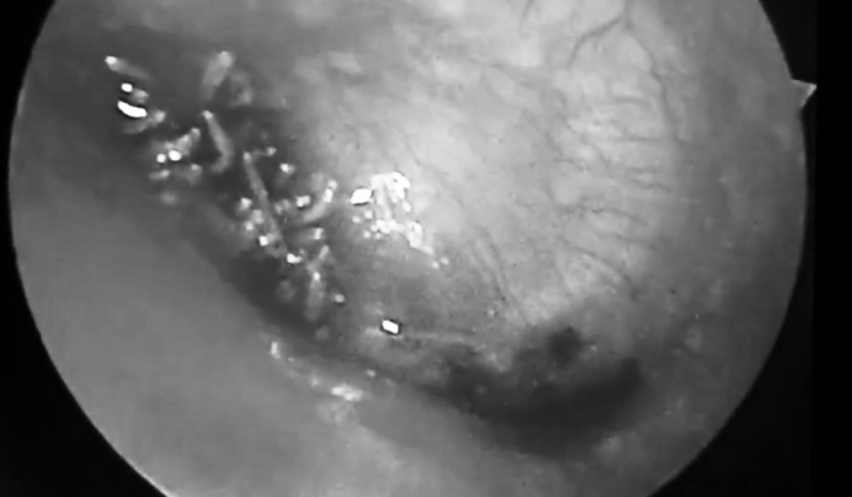 Hình ảnh giòi lúc nhúc trong tai người bệnh