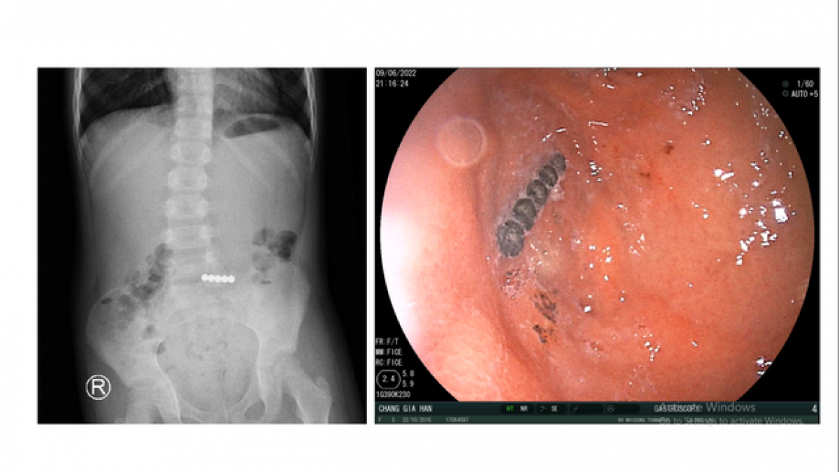 Hình ảnh Xquang cho thấy các viên bi nam châm "chạy" xuống ruột non, các bác sĩ phải nội soi gắp ra (ảnh: BVCC)
