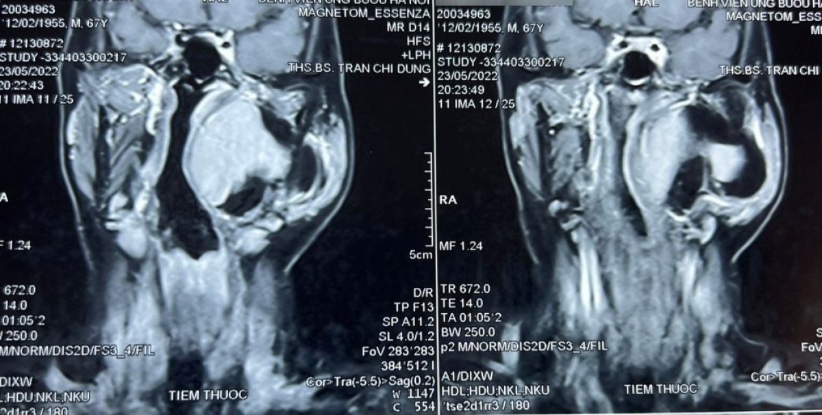 Hình ảnh chụp khối u chiếm phần lớn diện tích ngay dưới nền sọ