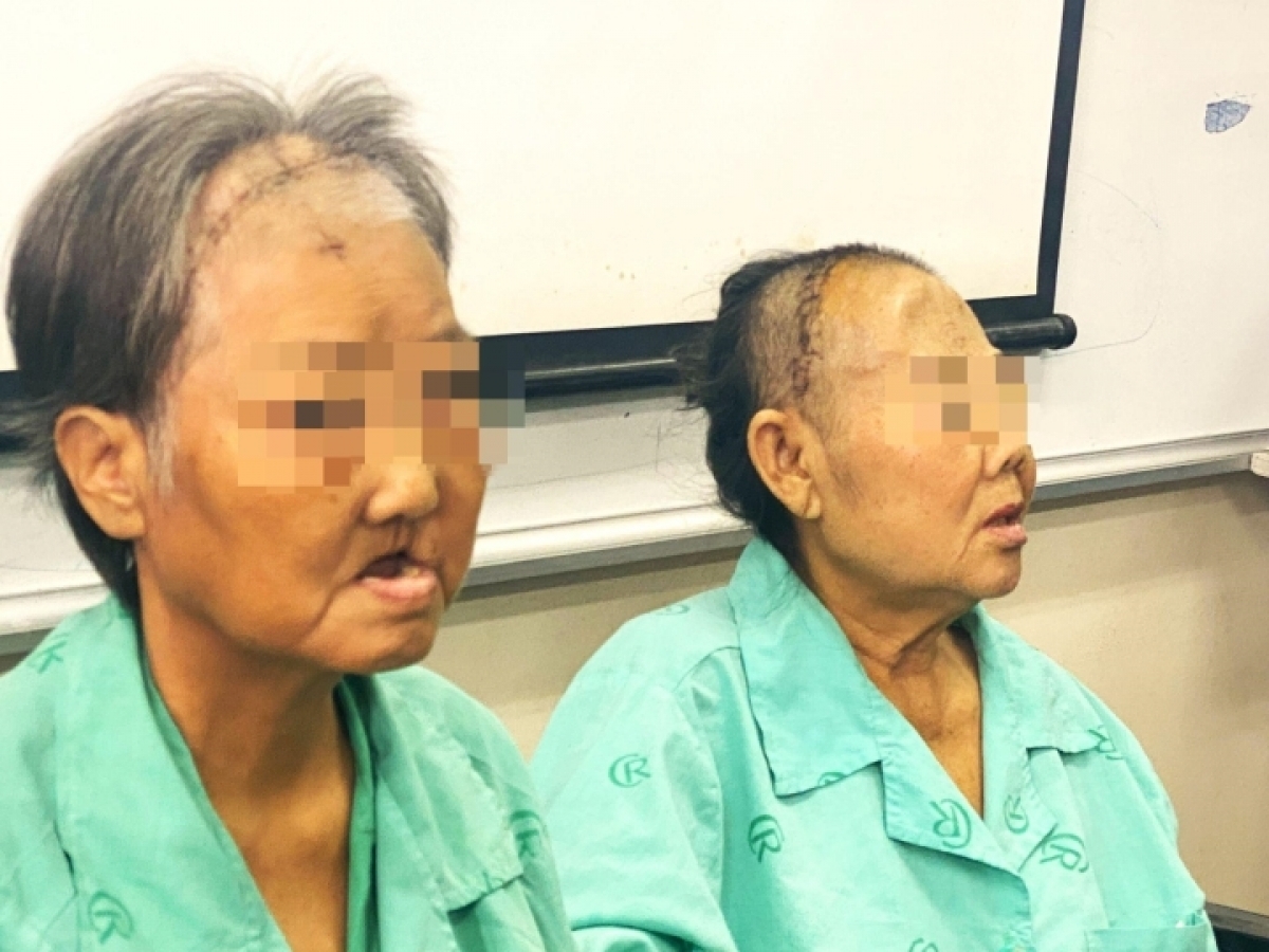 2 trong số những trường hợp bị hoại tử xương hàm mặt hậu Covid-19 ở Việt Nam