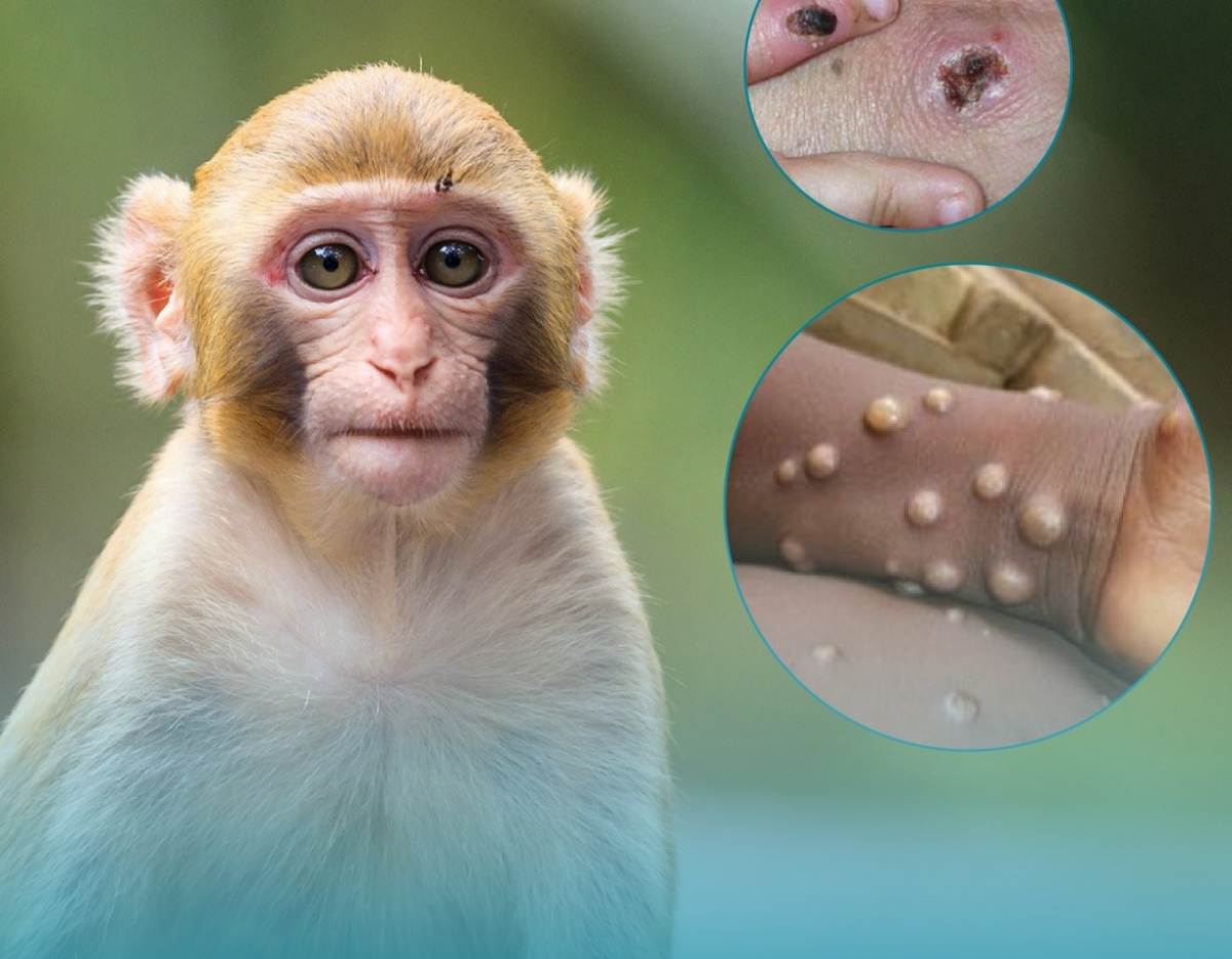 Theo Bộ Y tế, bệnh đậu mùa khỉ có các triệu chứng chính là sốt, phát ban dạng phỏng nước và sưng hạch ngoại vi, có thể gây biến chứng nặng dẫn tới tử vong