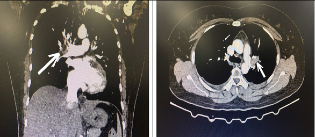 Hình ảnh CT lồng ngực bệnh nhân bị tắc động mạch phổi cấp tính - Ảnh: BVCC
