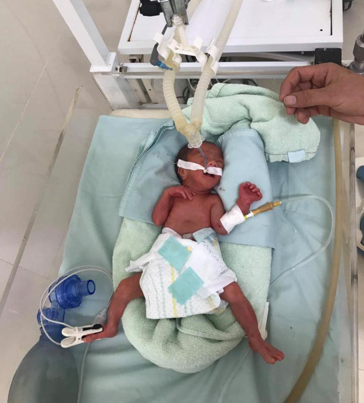 Một trường hợp trẻ sinh non đang được chăm sóc, nuôi dưỡng tại Bệnh viện Phụ sản TW