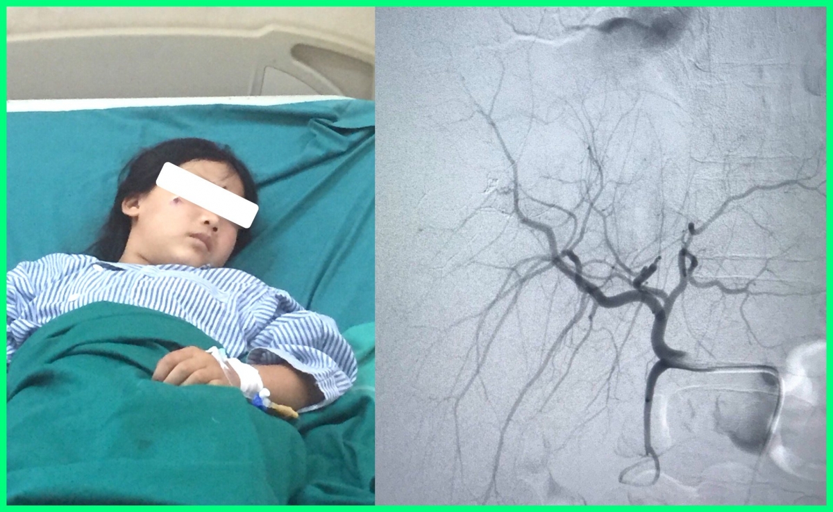 Bệnh nhân bị vỡ gan được cứu sống bằng kỹ thuật nút mạch gan tại BVĐK tỉnh Hà Giang