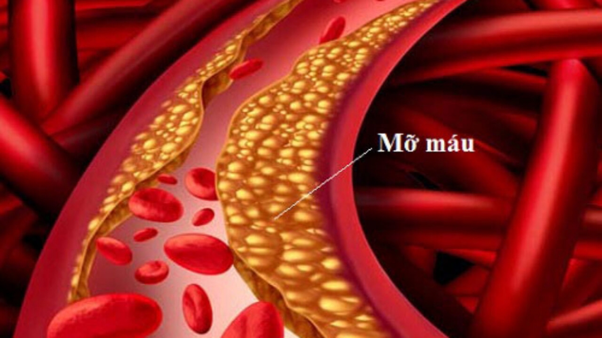 Rối loạn lipid máu dẫn tới hình thành các mảng xơ vữa trong lòng mạch, gây hẹp và bít tắc mạch máu