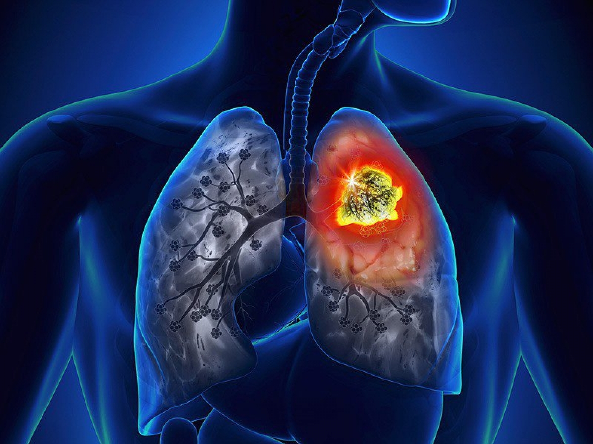 Gần 97% bệnh nhân ung thư phổi có hút thuốc lá 