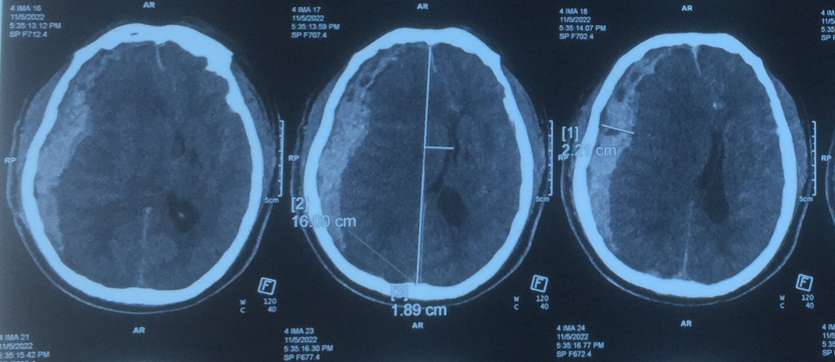 Hình ảnh CT sọ não của bệnh nhân: máu tụ dưới màng cứng bán cầu phải