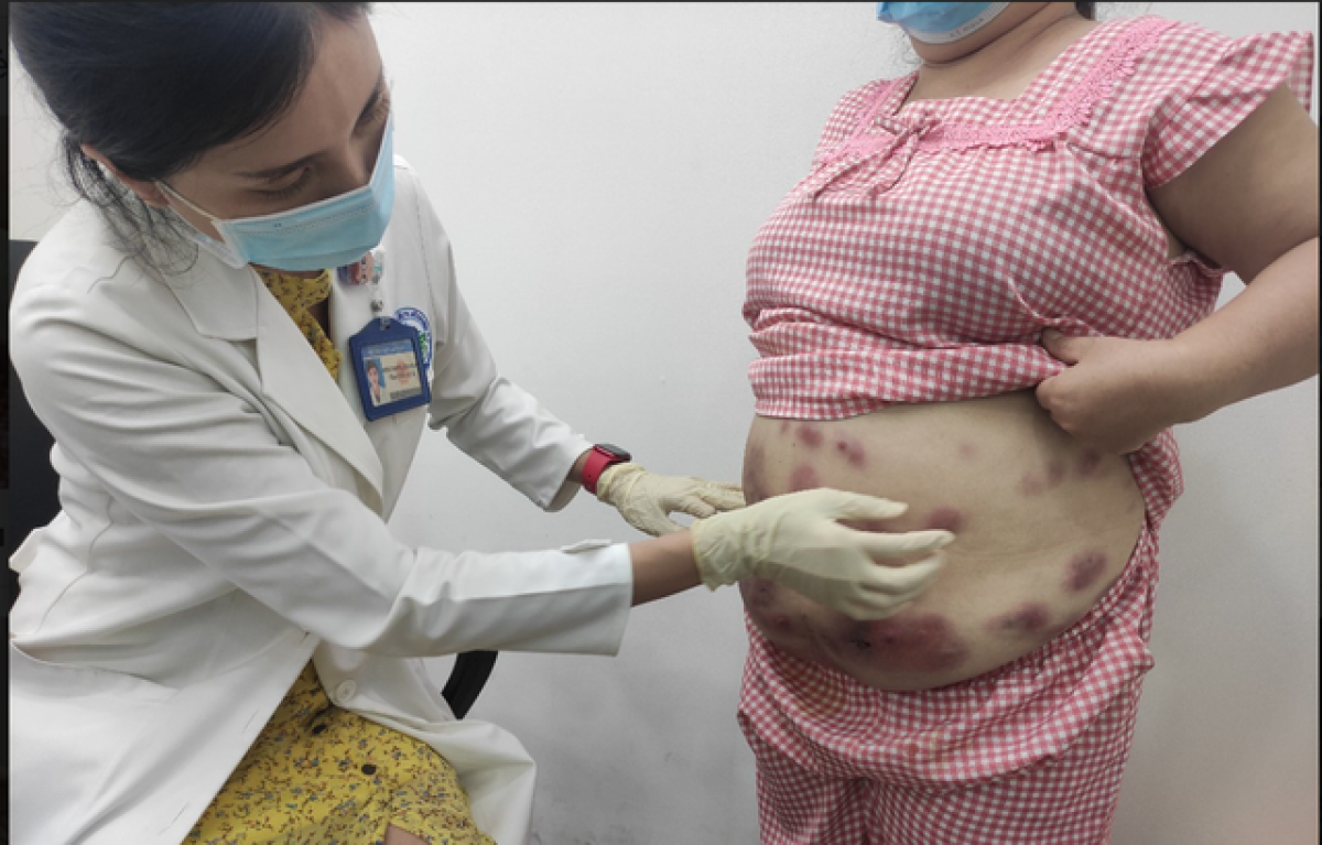 BS.CK2 Phạm Thị Thanh Giang khám cho bệnh nhân bị tai biến do tiêm tan mỡ
