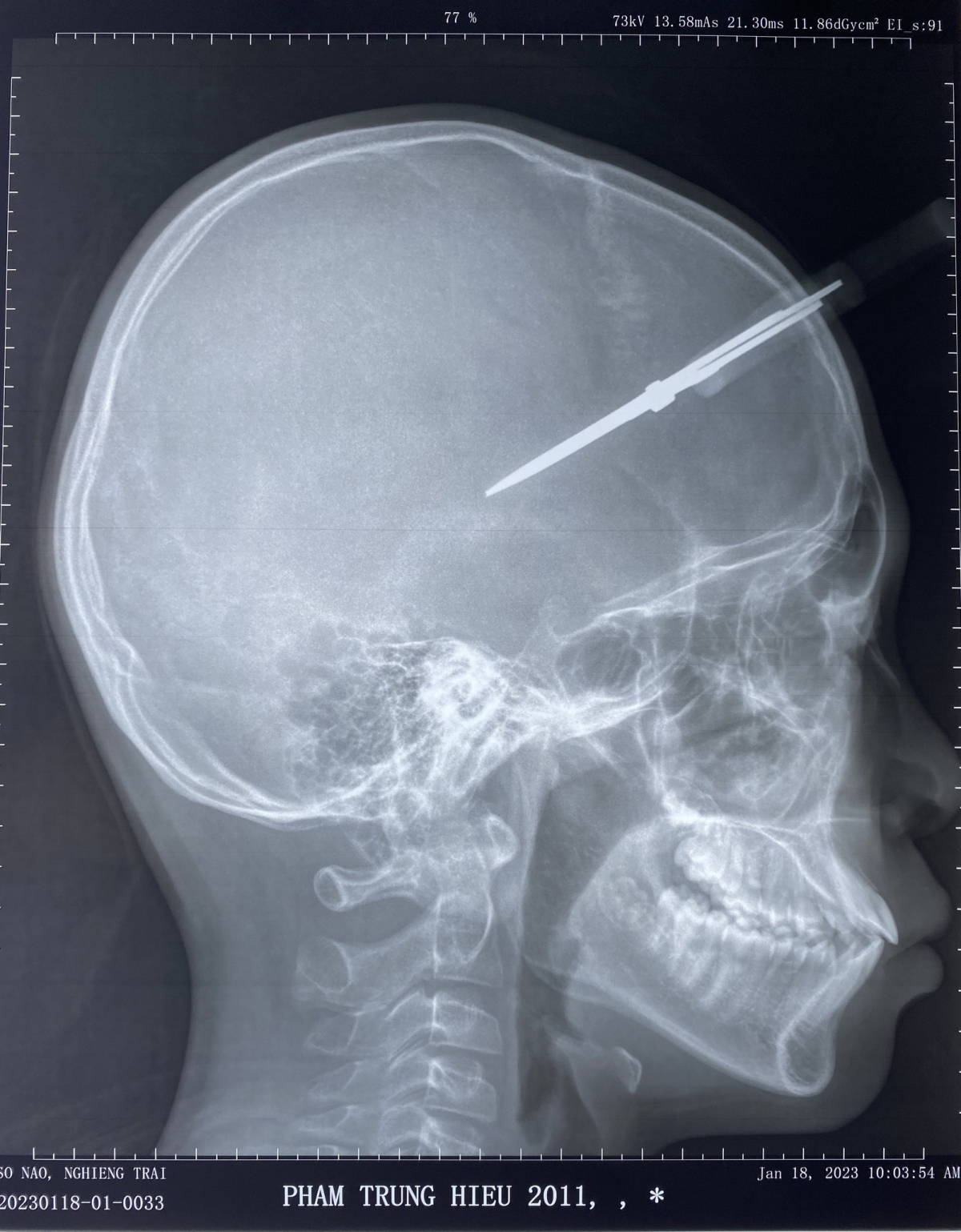 Trên phim chụp cây kéo đã xuyên qua xương sọ vào trong hộp sọ của bệnh nhi.
