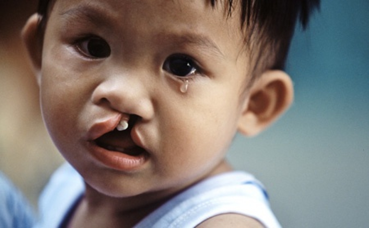 Sứt môi hở hàm ếch là dị tật bẩm sinh thường gặp ở trẻ