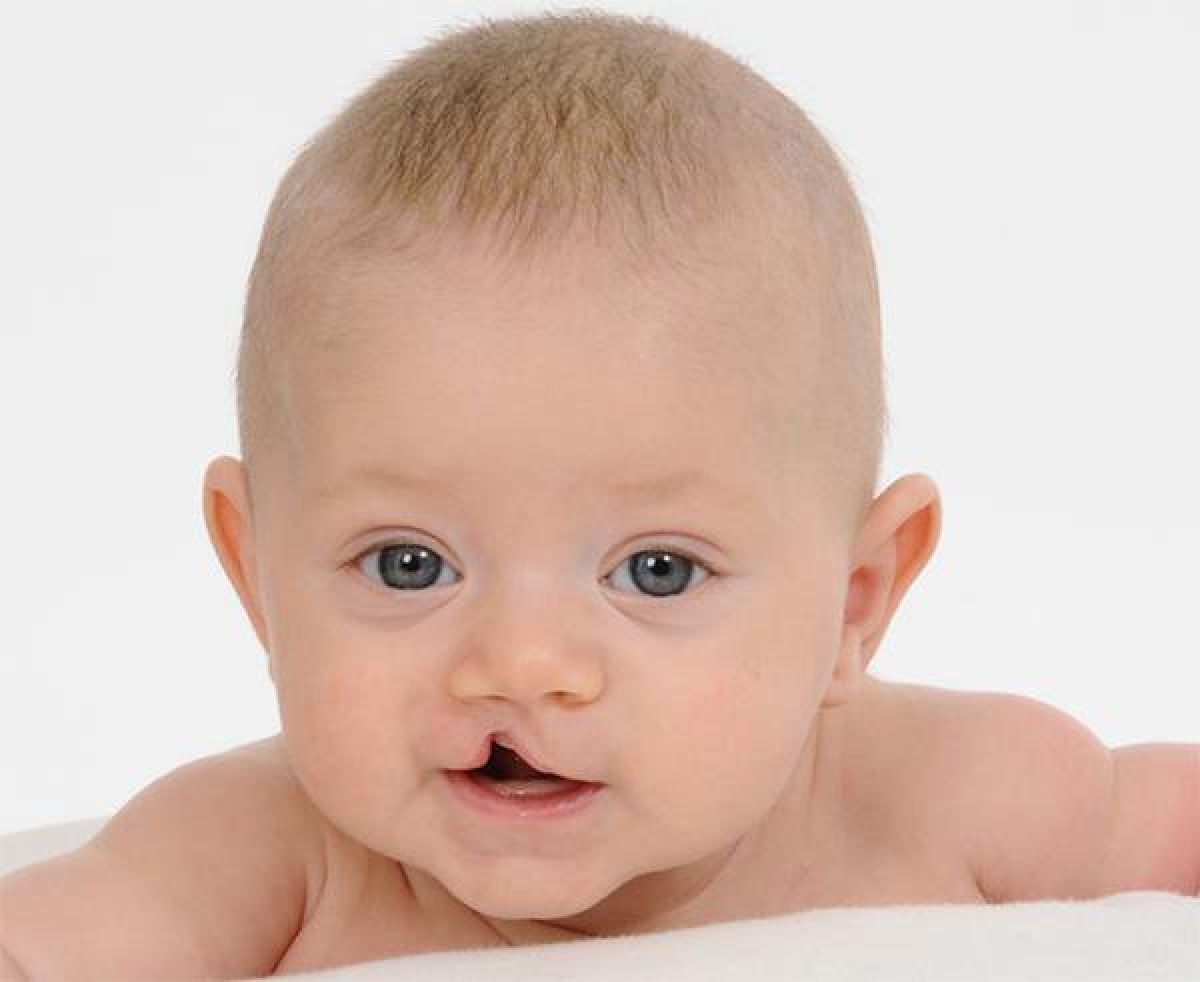 Người mẹ bị nhiễm virus cúm trong 3 tháng đầu mang thai có thể sinh con ra bị dị tật khe hở môi - vòm miệng