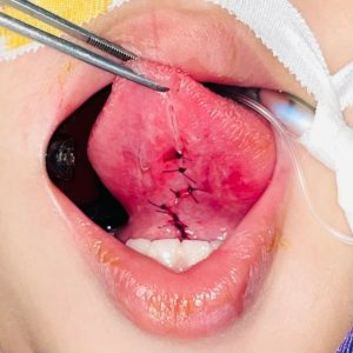 Phẫu thuật tạo hình phanh lưỡi cho trẻ- Ảnh: BVCC